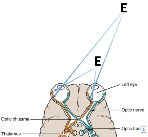 diagram of optic tracts, showing that fibers from the nasal side of each retina cross to the opposite side of the brain while fibers from the lateral side of each retina go straight back to the same side of the brain. both eyes are looking at an 'E' to the right.